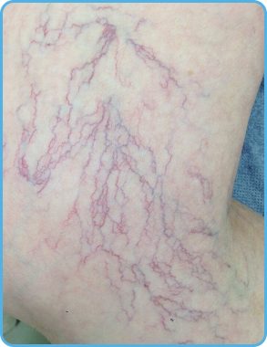 Chemical Peels